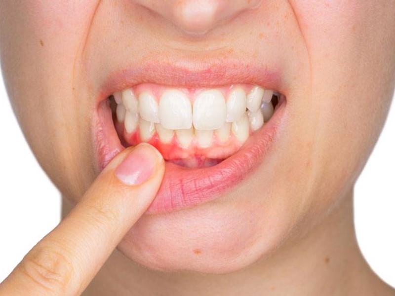 Periodontal Treatment