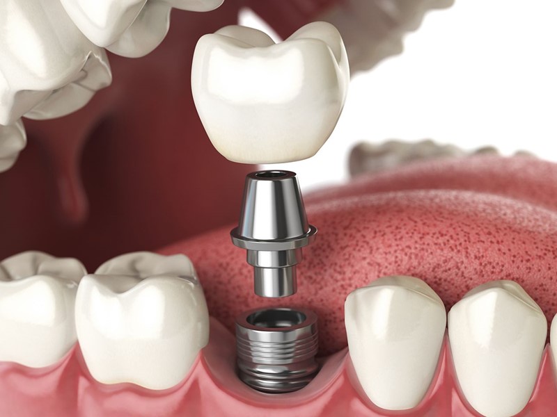Dental Implants