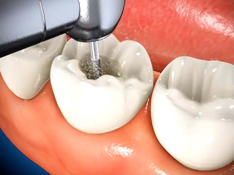 Root Canal