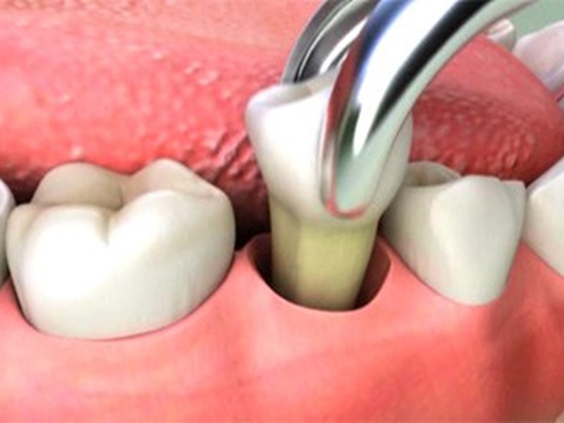 Advice following Dental Extractions