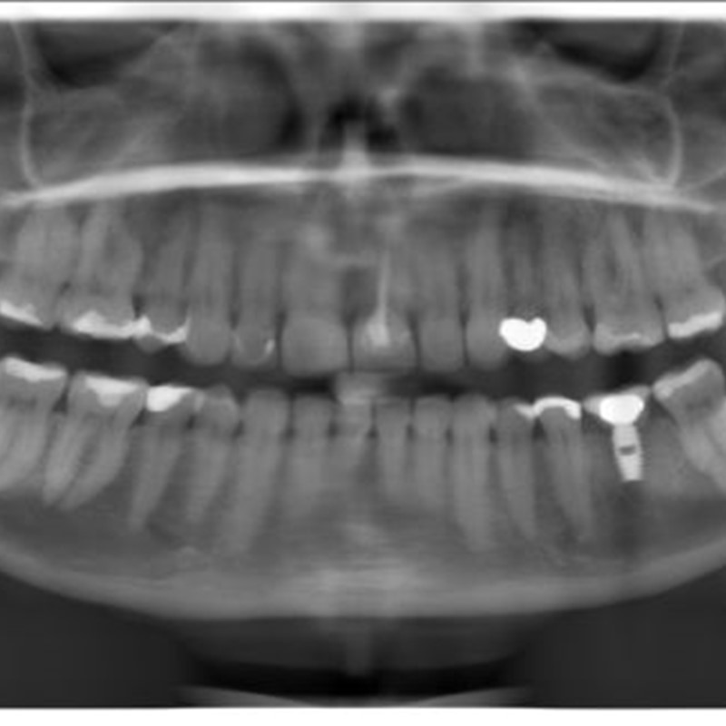 Panoramic X-Ray - Full Face X-Ray